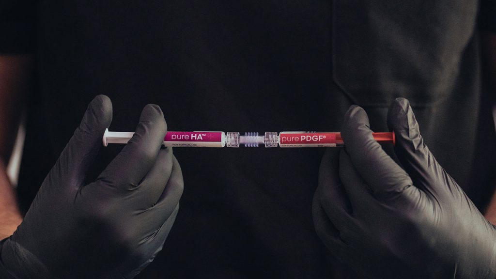 Ariessence pure PDGF+ and pure HA topical syringes applied during SkinPen microneedling